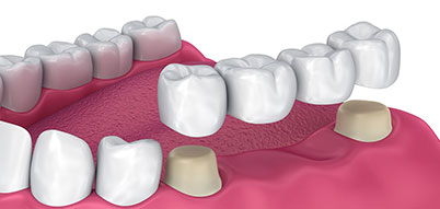 4 Unit Dental Bridge | Whites Dental