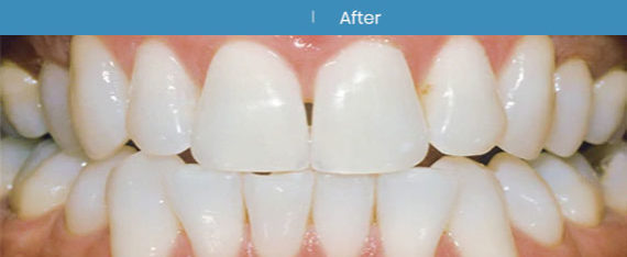 After Teeth Whitening | Whites Dental