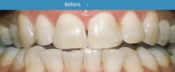Before Teeth Whitening | Whites Dental