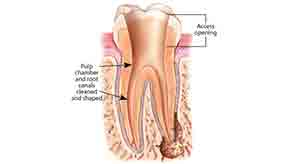 Root canal Treatment | Whites Dental