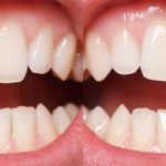Composite Bonding | Whites Dental