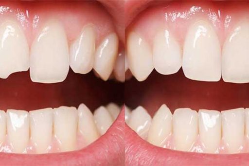 Composite Bonding | Whites Dental