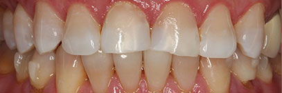 Close up of composite veneers before treatment