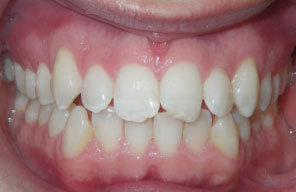 Orthodontist in London Waterloo | Whites Dental