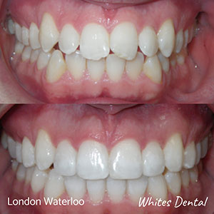 Orthodontic Braces & Invisalign In London | Whites Dental