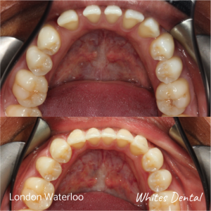 Invisalign braces before after | Orthodontist in London Waterloo 1