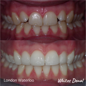 Invisalign braces before after | Orthodontist in London Waterloo 7