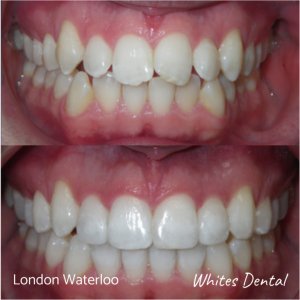 Invisalign braces before after | Orthodontist in London Waterloo 9
