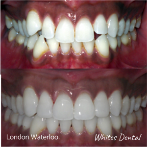 Invisalign braces before after | Orthodontist in London Waterloo 6