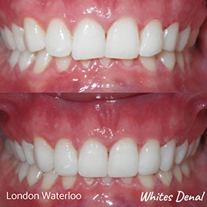 A before and after image of composite bonding performed on a client.