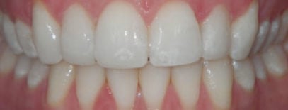 Invisalign Before and After London Bridge | Whites Dental