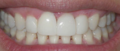 Invisalign Before and After London Bridge | Whites Dental