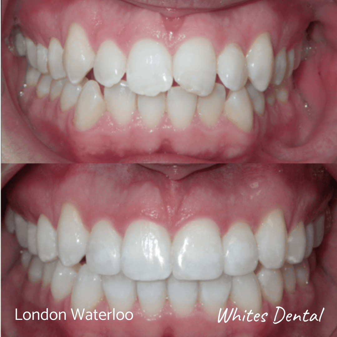 Fixed braces before and after. Whites Dental in London Waterloo