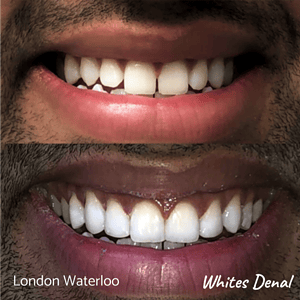 Composite Bonding before after | Cosmetic Dentist in London Waterloo 6