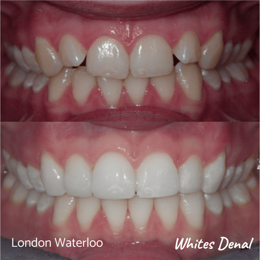 Composite bonding before and after. Whites Dental in London Waterloo