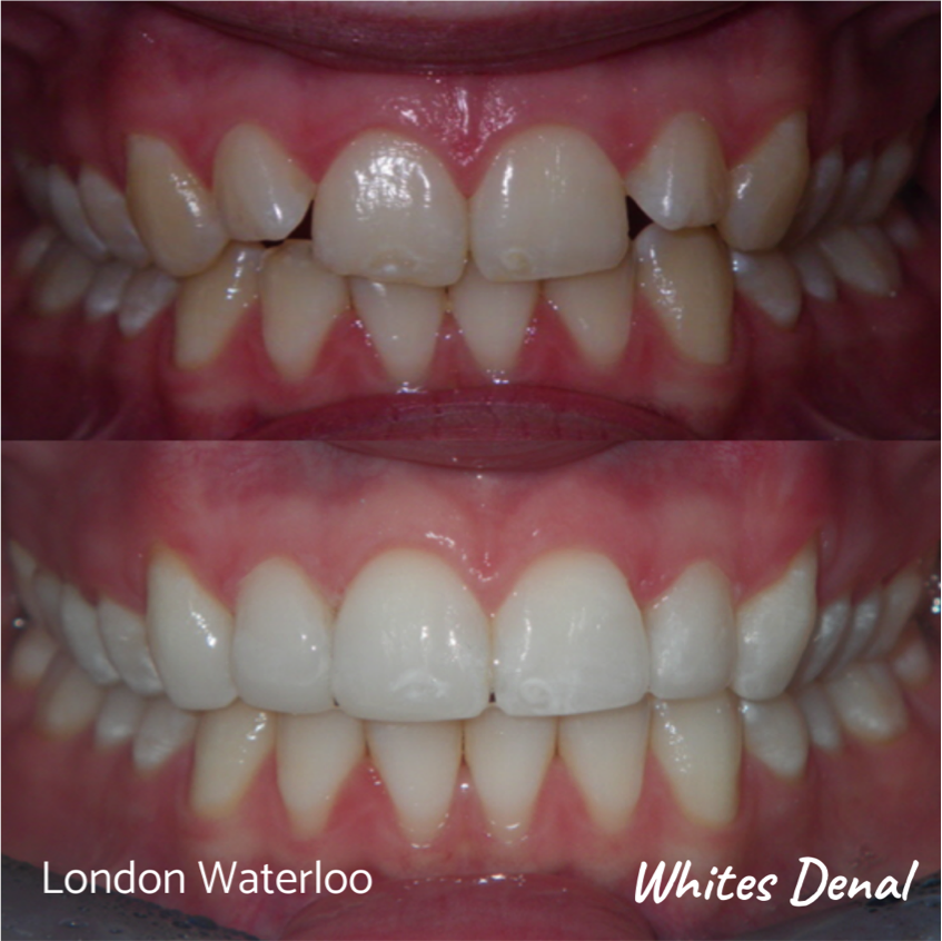 Fixed dental braces before after | Orthodontist in London Waterloo 9 | Whites Dental