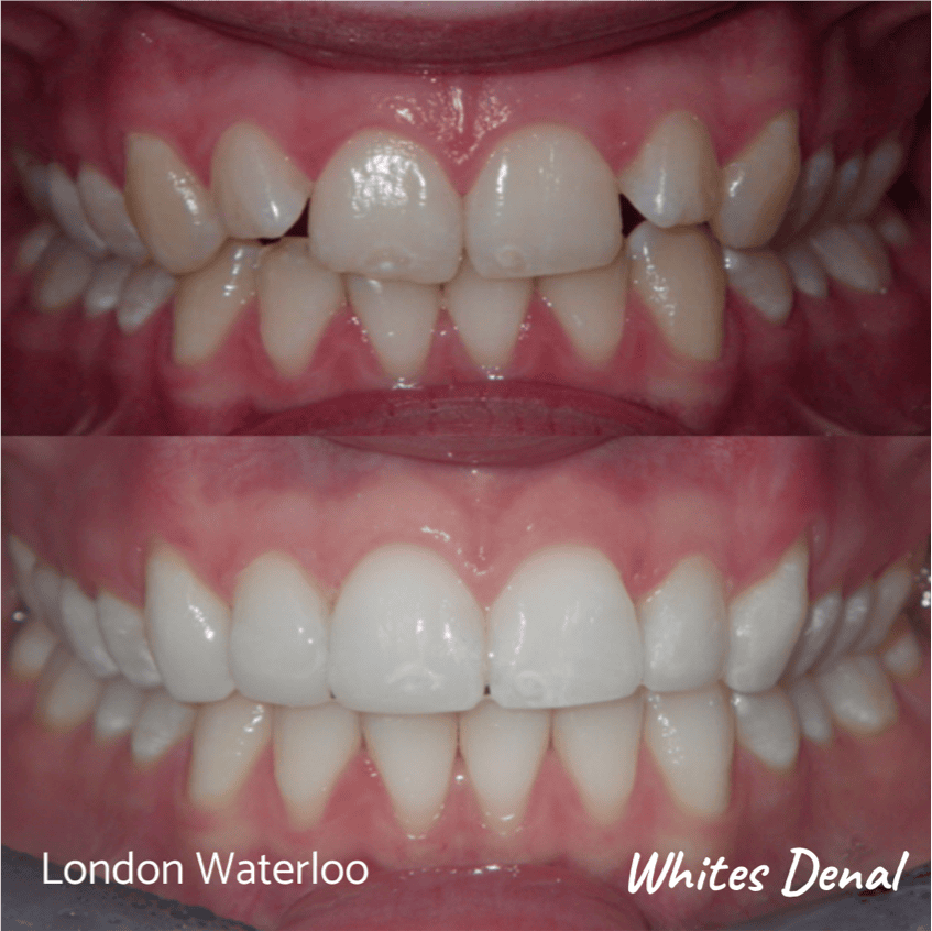 Fixed dental braces before after | Orthodontist in London Waterloo 9 | Whites Dental