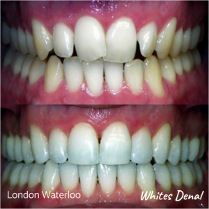 Fixed dental braces before after | Orthodontist in London Waterloo 6