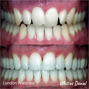 Fixed dental braces before after | Orthodontist in London Waterloo 6