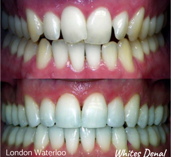 Fixed dental braces before after | Orthodontist in London Waterloo 6 | Whites Dental