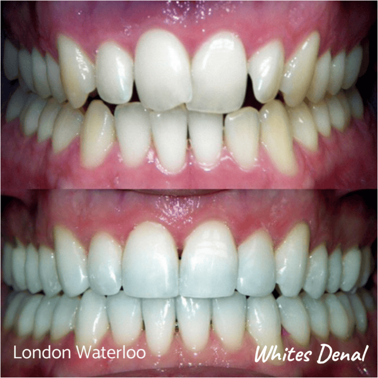 Fixed dental braces before after | Orthodontist in London Waterloo 6 | Whites Dental