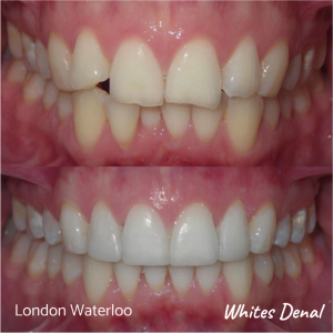 Fixed dental braces before after | Orthodontist in London Waterloo 3