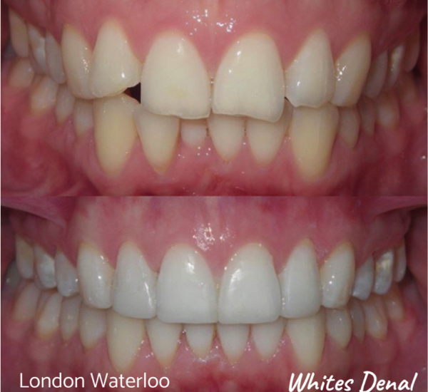 Fixed dental braces before after | Orthodontist in London Waterloo 3 | Whites Dental