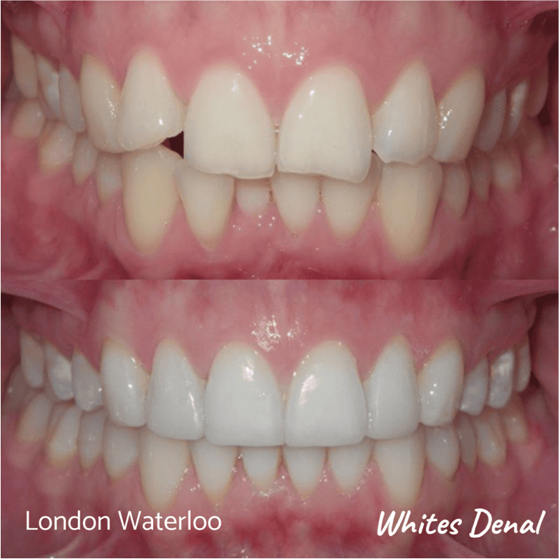 Fixed dental braces before after | Orthodontist in London Waterloo 3 | Whites Dental