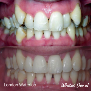 Fixed dental braces before after | Orthodontist in London Waterloo 8