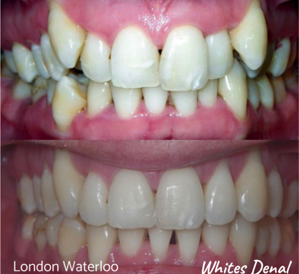 Fixed dental braces before after | Orthodontist in London Waterloo 8 | Whites Dental