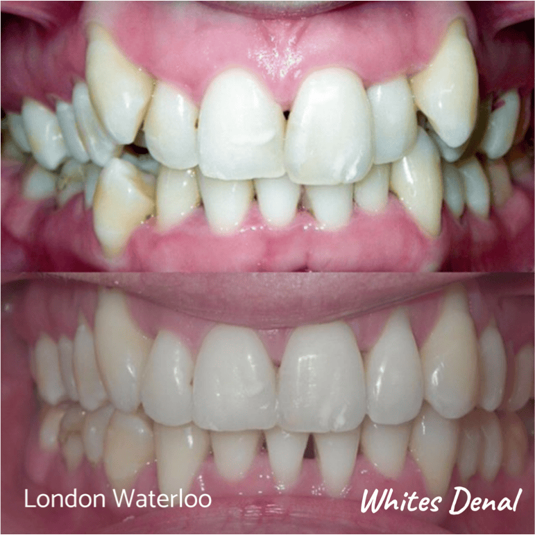 Fixed dental braces before after | Orthodontist in London Waterloo 8 | Whites Dental