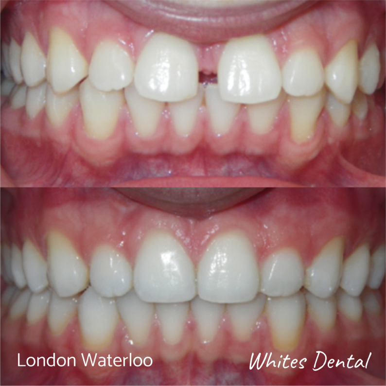 Fixed dental braces before after | Orthodontist in London Waterloo 5 | Whites Dental