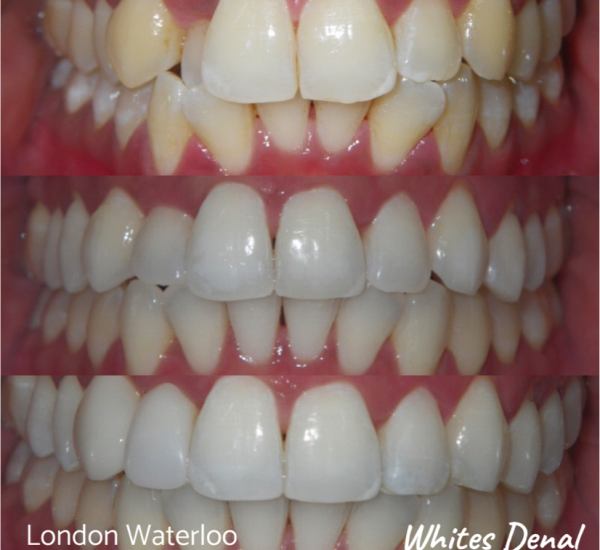 Fixed dental braces before after | Orthodontist in London Waterloo 2 | Whites Dental
