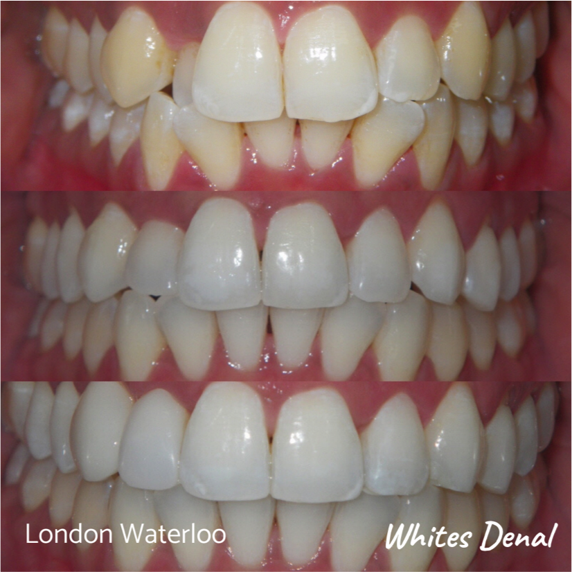 Fixed dental braces before after | Orthodontist in London Waterloo 2 | Whites Dental