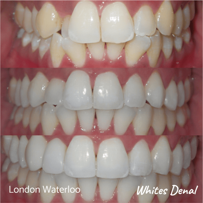 Fixed dental braces before after | Orthodontist in London Waterloo 2 | Whites Dental