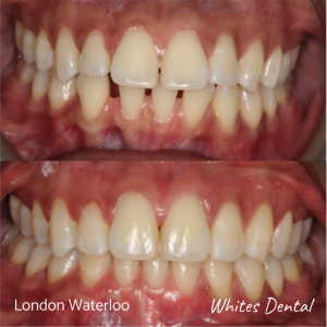 Fixed dental braces before after | Orthodontist in London Waterloo 7