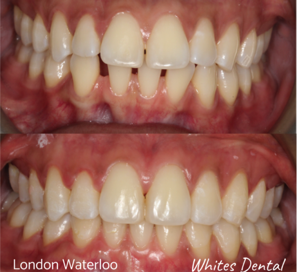 Fixed dental braces before after | Orthodontist in London Waterloo 7 | Whites Dental