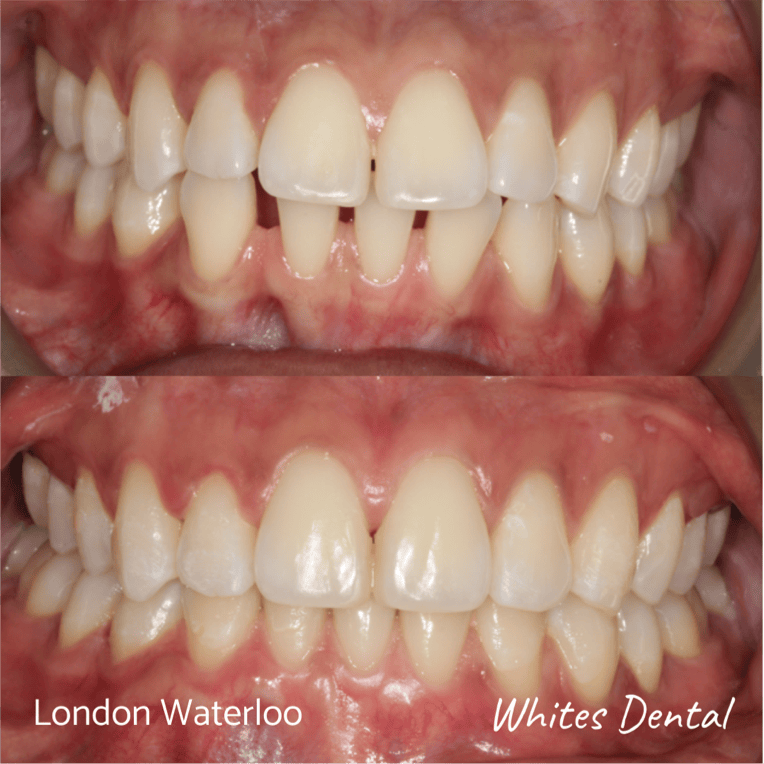 Fixed dental braces before after | Orthodontist in London Waterloo 7 | Whites Dental