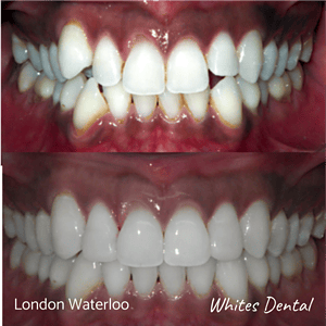 Fixed dental braces before after | Orthodontist in London Waterloo 4
