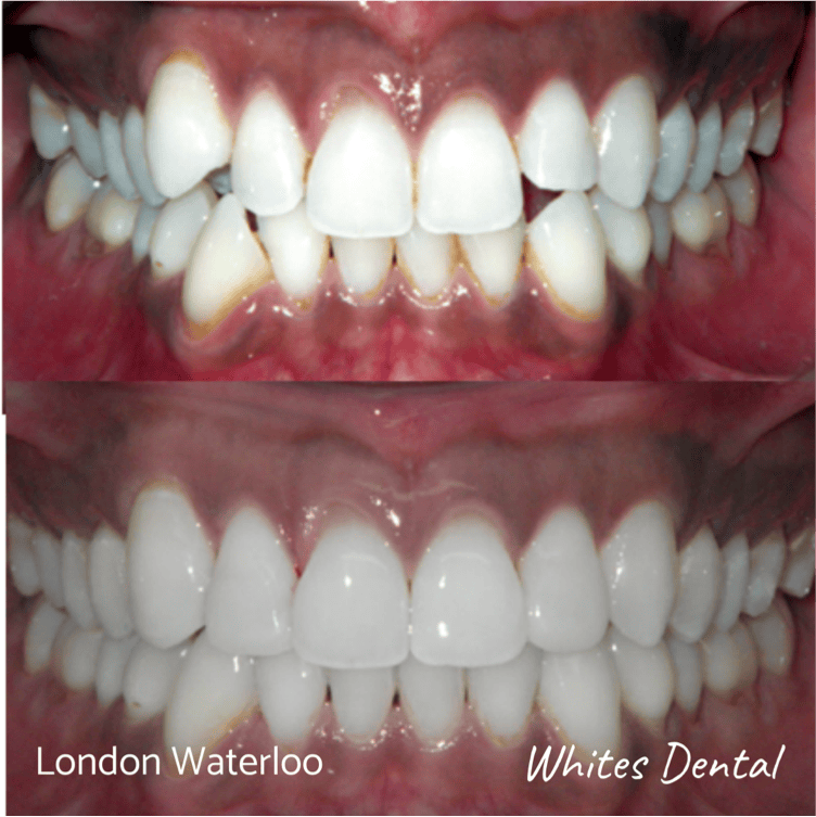 Fixed dental braces before after | Orthodontist in London Waterloo 4 | Whites Dental