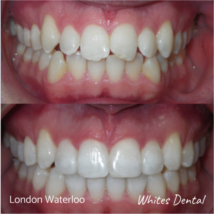 Fixed dental braces before after | Orthodontist in London Waterloo 1 | Whites Dental