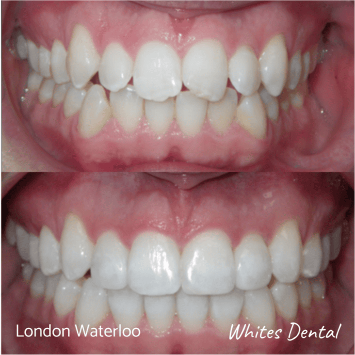 Fixed dental braces before after | Orthodontist in London Waterloo 1 | Whites Dental