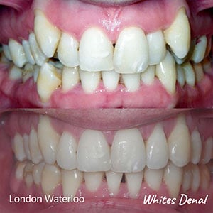 Orthodontic Braces & Invisalign In London | Whites Dental