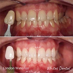 best teeth whitening cosmetic dentistry london waterloo cosmetic dentist in london | Whites Dental