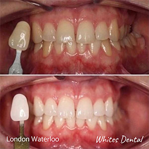 zoom laser teeth whitening london waterloo cosmetic dentist in london | Whites Dental