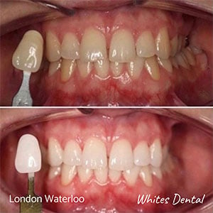 professional teeth whitening cosmetic dentistry london elephant castle cosmetic dentist in london | Whites Dental