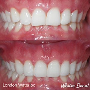 Fixed Braces in London | Orthodontist London Waterloo | Whites Dental