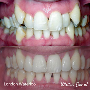 Metal and ceramic braces cost | Orthodontist in London Waterloo | Whites Dental