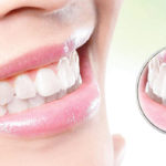 Smile Makeover | Whites Dental