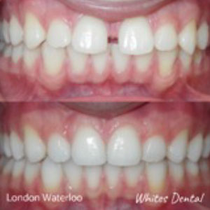 Fixed Braces For Teens in London | Orthodontist London Waterloo | Whites Dental